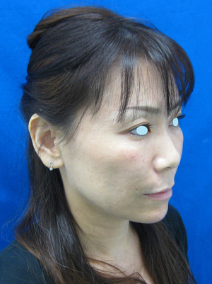 目の下のたるみ、目のくまでお悩みの方、切らずに完璧に解決します。TCB-R法　手術直後　症例写真